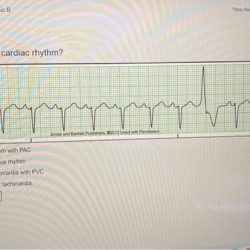 Test answers relias dysrhythmia basic a 35 questions